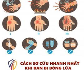CÁCH SƠ CỨU NHANH NHẤT KHI BẠN BỊ BỎNG LỬA 