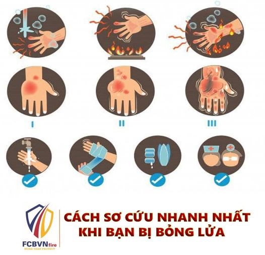 CÁCH SƠ CỨU NHANH NHẤT KHI BẠN BỊ BỎNG LỬA 